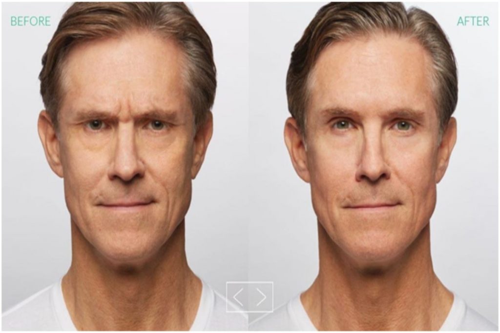 Dysport Injections